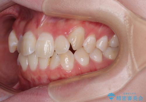 【モニター】前歯のデコボコをスッキリ解消!目立ちにくいワイヤー矯正でスピーディに治療完了の治療前