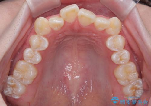 【モニター】前歯のデコボコをスッキリ解消!目立ちにくいワイヤー矯正でスピーディに治療完了の治療前