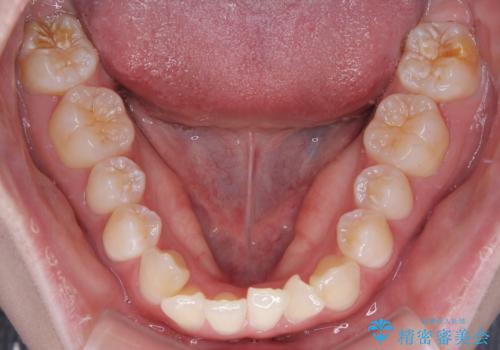 【モニター】前歯のデコボコをスッキリ解消!目立ちにくいワイヤー矯正でスピーディに治療完了の治療前