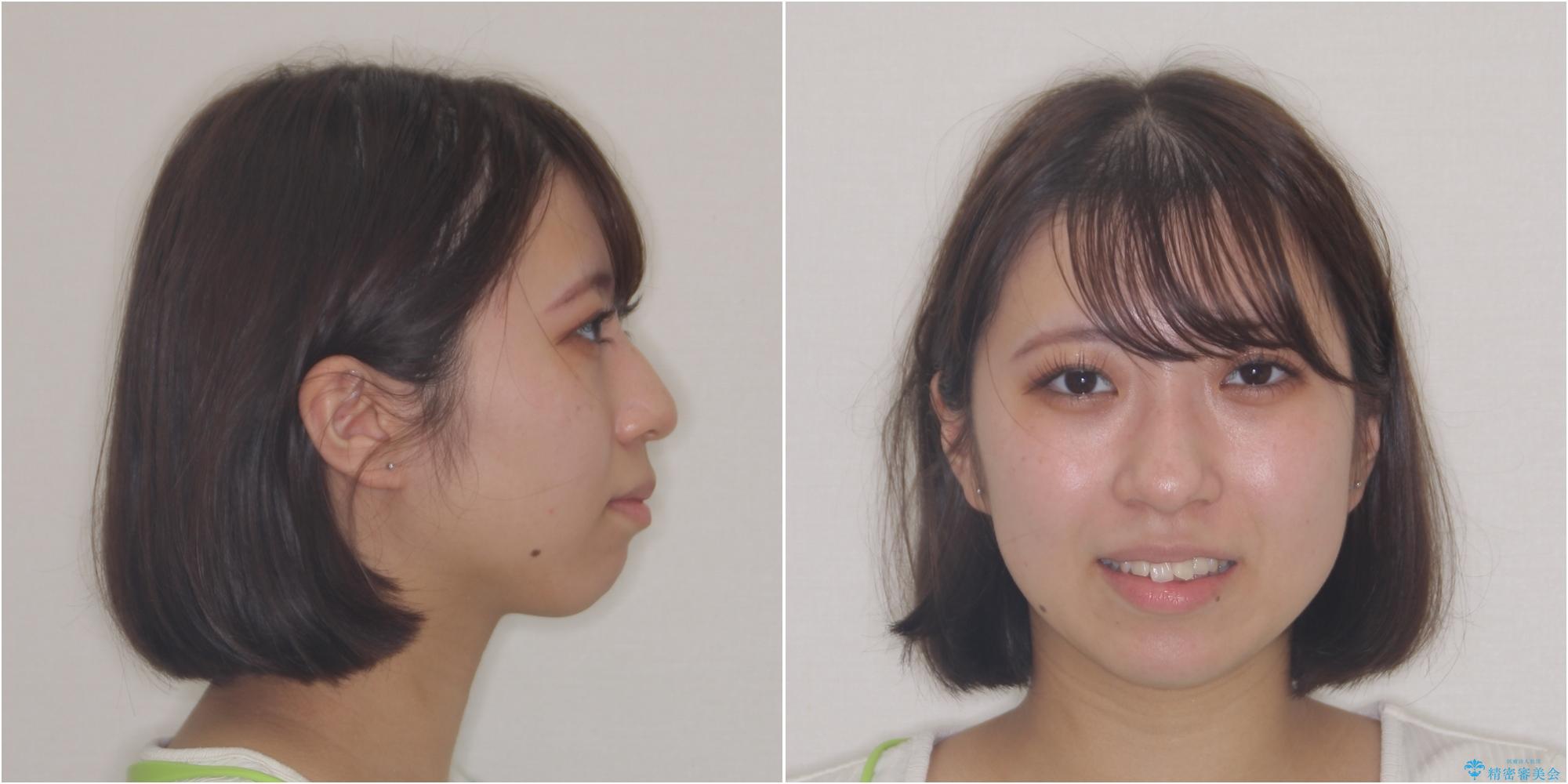 【モニター】とがった口元を抜歯して改善 ワイヤー装置の矯正治療の治療前(顔貌)