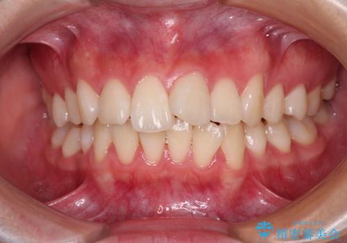 【モニター】とがった口元を抜歯して改善 ワイヤー装置の矯正治療の症例 治療前