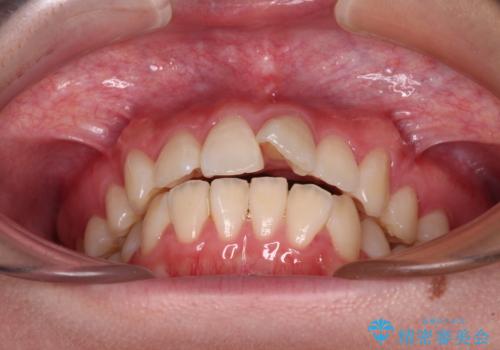 【モニター】とがった口元を抜歯して改善 ワイヤー装置の矯正治療の治療前