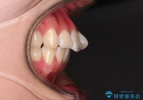 【モニター】とがった口元を抜歯して改善 ワイヤー装置の矯正治療の治療前