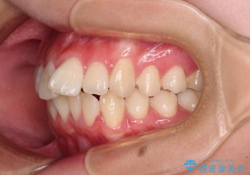 【モニター】とがった口元を抜歯して改善 ワイヤー装置の矯正治療の治療前