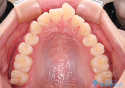 【モニター】とがった口元を抜歯して改善 ワイヤー装置の矯正治療の治療前