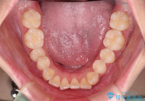 【モニター】とがった口元を抜歯して改善 ワイヤー装置の矯正治療の治療前