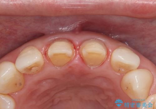 前歯の色が気になる　オールセラミッククラウンで綺麗で健康な歯にの治療中