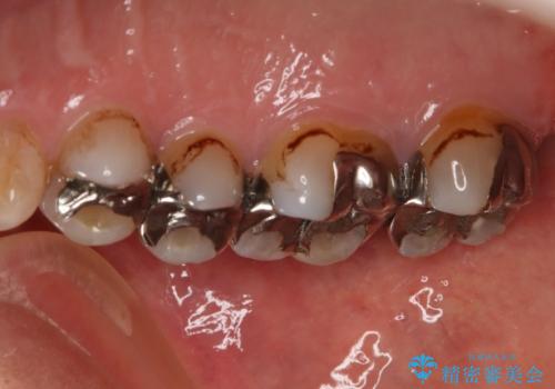 銀歯からセラミックへの治療前