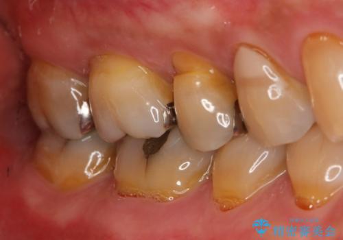 銀歯からセラミックへの症例 治療前