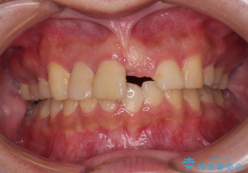 転んで折れてしまった前歯 インプラント補綴治療の治療前