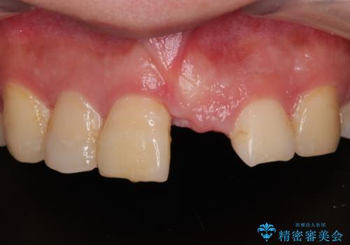 転んで折れてしまった前歯 インプラント補綴治療の症例 治療前