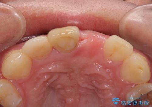 転んで折れてしまった前歯 インプラント補綴治療の治療前