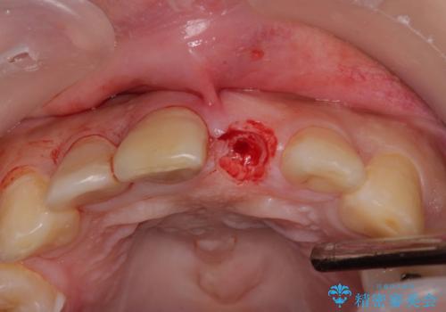 転んで折れてしまった前歯 インプラント補綴治療の治療前