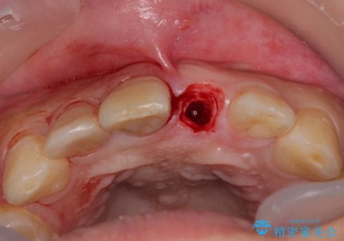 転んで折れてしまった前歯 インプラント補綴治療の治療中