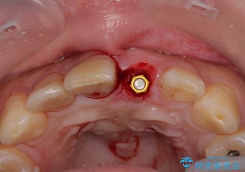 転んで折れてしまった前歯 インプラント補綴治療の治療後