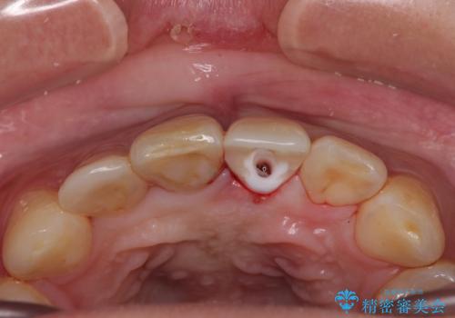 転んで折れてしまった前歯 インプラント補綴治療の治療中