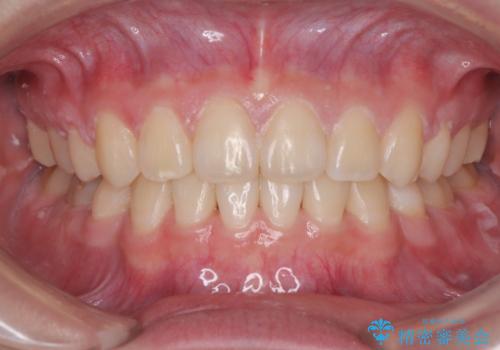 転勤でも安心して治療継続 抜歯スペース閉鎖と深い噛み合わせ改善のワイヤー矯正の症例 治療後