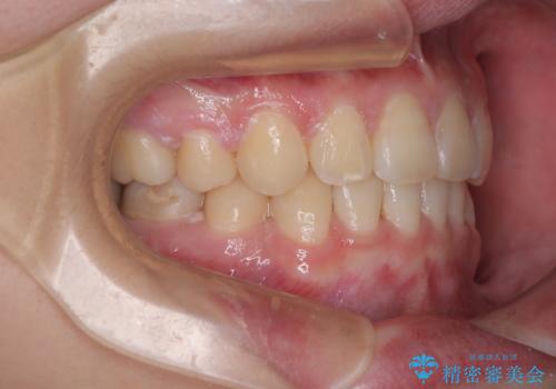 転勤でも安心して治療継続 抜歯スペース閉鎖と深い噛み合わせ改善のワイヤー矯正の治療後
