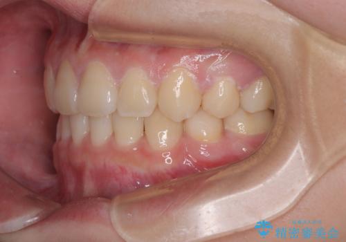 転勤でも安心して治療継続 抜歯スペース閉鎖と深い噛み合わせ改善のワイヤー矯正の治療後