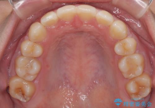 転勤でも安心して治療継続 抜歯スペース閉鎖と深い噛み合わせ改善のワイヤー矯正の治療後