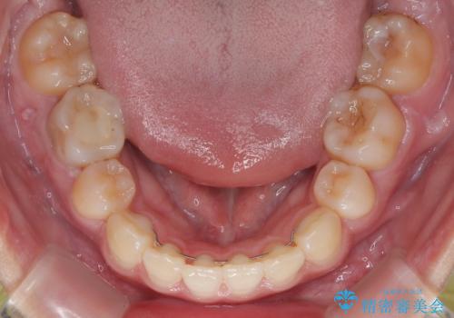 転勤でも安心して治療継続 抜歯スペース閉鎖と深い噛み合わせ改善のワイヤー矯正の治療後