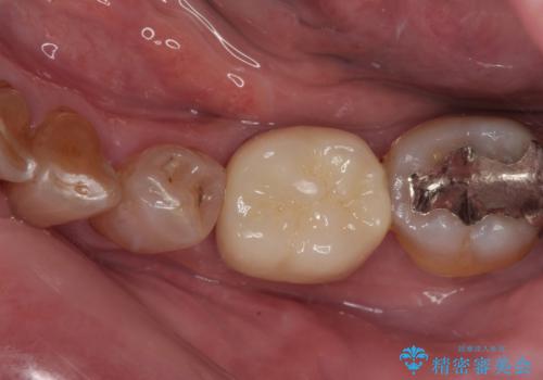 痛くて噛めない　オールセラミッククラウンでのむし歯治療の症例 治療後