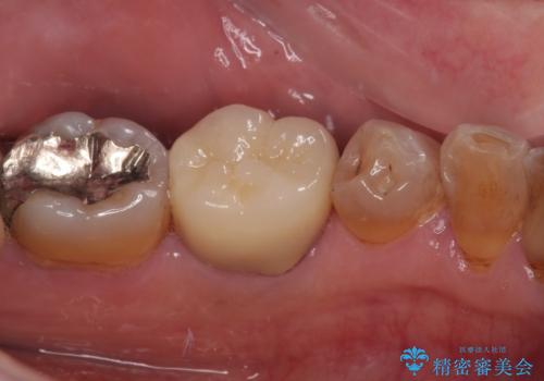 痛くて噛めない オールセラミッククラウンでのむし歯治療の治療後