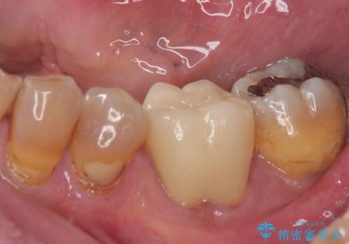 痛くて噛めない オールセラミッククラウンでのむし歯治療の治療後