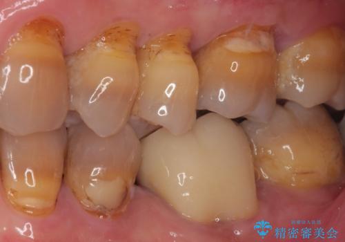 痛くて噛めない オールセラミッククラウンでのむし歯治療の治療後