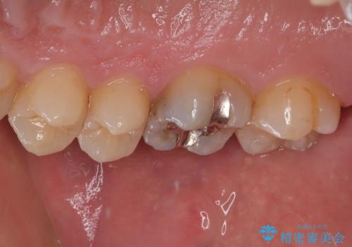 舌で触ると段差が気になる ゴールドインレー修復の治療前