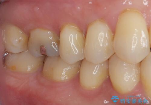 舌で触ると段差が気になる ゴールドインレー修復の治療前