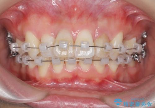 がたつきと出っ歯 ワイヤー矯正での歯並び改善の治療前