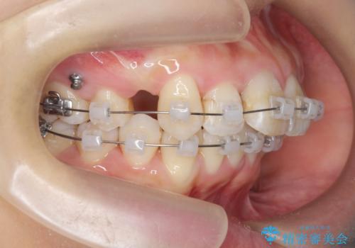 がたつきと出っ歯 ワイヤー矯正での歯並び改善の治療前