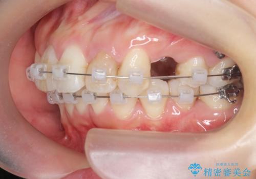 がたつきと出っ歯 ワイヤー矯正での歯並び改善の治療前