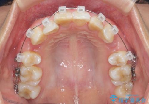 がたつきと出っ歯 ワイヤー矯正での歯並び改善の治療前