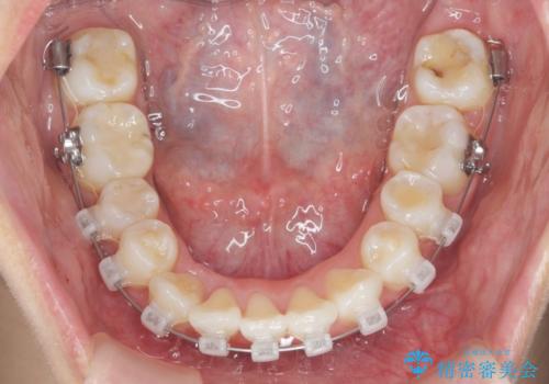 がたつきと出っ歯 ワイヤー矯正での歯並び改善の治療前