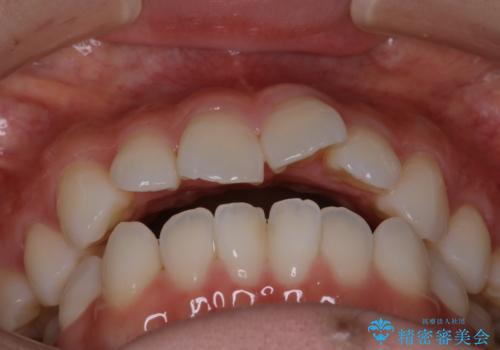 【審美装置】前歯で噛めない!抜歯しないで治したいの治療前