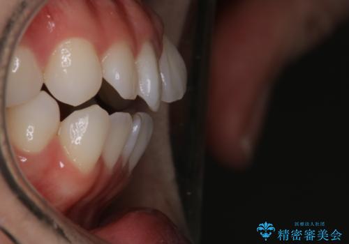 【審美装置】前歯で噛めない!抜歯しないで治したいの治療前