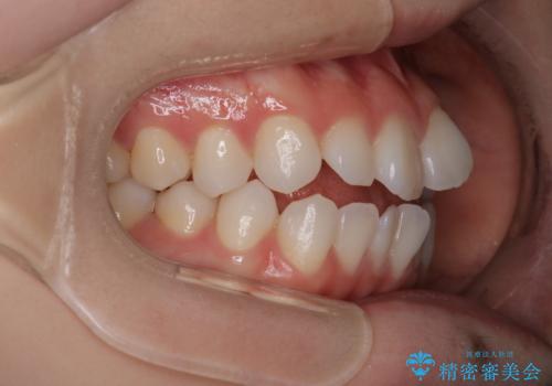 【審美装置】前歯で噛めない!抜歯しないで治したいの治療前