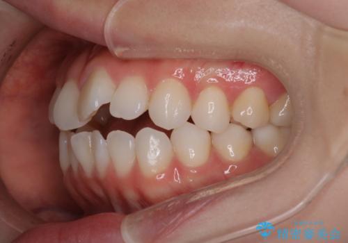 【審美装置】前歯で噛めない!抜歯しないで治したいの治療前