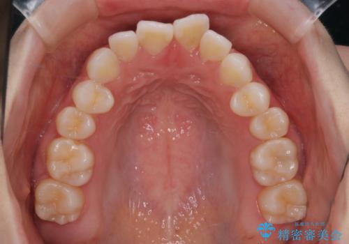 【審美装置】前歯で噛めない!抜歯しないで治したいの治療前