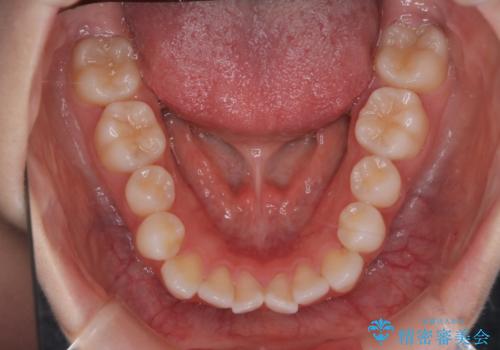 【審美装置】前歯で噛めない!抜歯しないで治したいの治療前