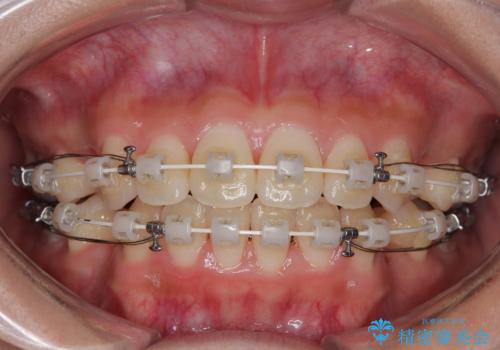 急速拡大装置 狭い骨幅を拡大した上で、口元の突出感を改善する抜歯矯正治療の治療中
