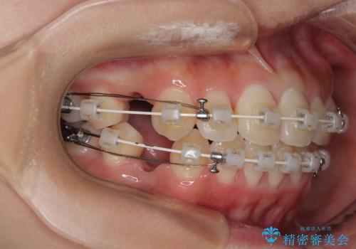 急速拡大装置 狭い骨幅を拡大した上で、口元の突出感を改善する抜歯矯正治療の治療中