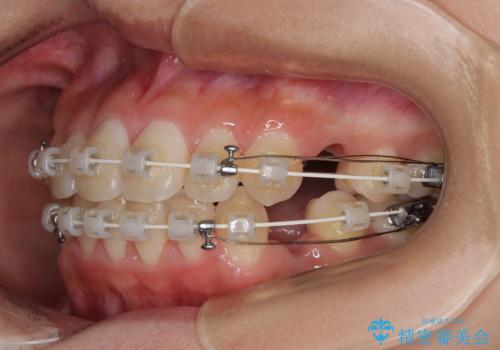 急速拡大装置 狭い骨幅を拡大した上で、口元の突出感を改善する抜歯矯正治療の治療中