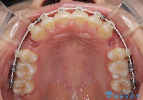 急速拡大装置 狭い骨幅を拡大した上で、口元の突出感を改善する抜歯矯正治療の治療中