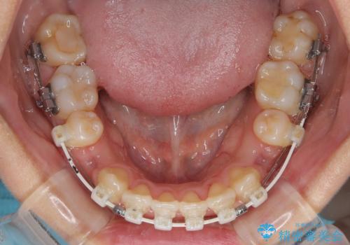 急速拡大装置 狭い骨幅を拡大した上で、口元の突出感を改善する抜歯矯正治療の治療中