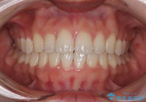 目立ちにくい表側装置で1年完了!狭いアーチを側方拡大し前歯のデコボコを整えた症例の症例 治療後