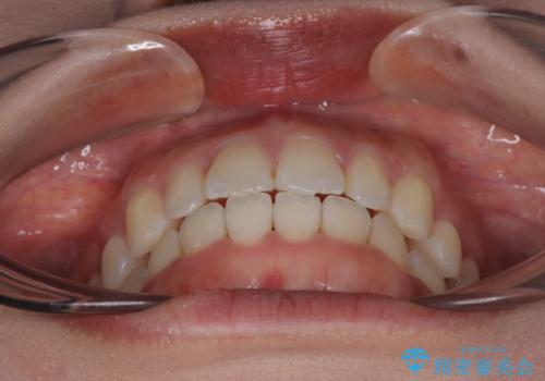 目立ちにくい表側装置で1年完了!狭いアーチを側方拡大し前歯のデコボコを整えた症例の治療後