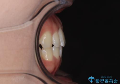 目立ちにくい表側装置で1年完了!狭いアーチを側方拡大し前歯のデコボコを整えた症例の治療後